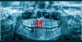 Pain Of Tooth Decay On Teeth X-Ray Royalty Free Stock Photo