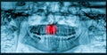 Pain Of Tooth Decay On Teeth X-Ray Royalty Free Stock Photo