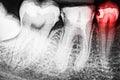 Pain Of Tooth Decay On X-Ray Royalty Free Stock Photo