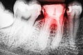 Pain Of Tooth Decay On X-Ray