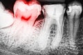 Pain Of Tooth Decay On X-Ray