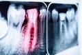 Pain Of Tooth Decay On X-Ray Royalty Free Stock Photo