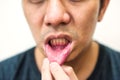 Pained aphtha ulcer mouth from accident Royalty Free Stock Photo