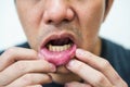 Pained aphtha ulcer at mouth Royalty Free Stock Photo