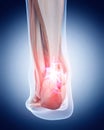 Painful achilles tendon Royalty Free Stock Photo