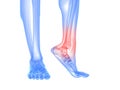 Painful ankle illustration