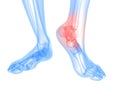 Painful ankle illustration