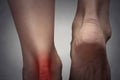 Painful ankle with red spot on woman's foot. Royalty Free Stock Photo