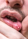 Painful aphtha ulcer on man's mouth Royalty Free Stock Photo