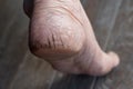 Painful cracked heel of Asian woman. Dry foot skin