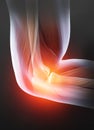 Painful elbow joint, rheumatoid arthritis, medically 3D illustration