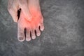 Painful foot of Asian man with diabetes. Sensory neuropathy problems. Foot nerves problems