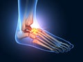 Painful foot joints, medical 3D illustration