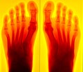Painful foot Xray Royalty Free Stock Photo
