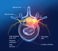 Painful herniated disk, medically 3D illustration on black background