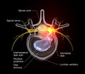 Painful herniated disk, medically 3D illustration on black background