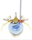 Painful herniated disk, minimally invasive operation, medically 3D illustration on white background