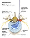 Painful herniated disk, minimally invasive operation, medically 3D illustration on white background