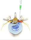 Painful herniated disk, minimally invasive therapy, medically 3D illustration on white background