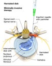 Painful herniated disk, minimally invasive therapy, medically 3D illustration on white background Royalty Free Stock Photo