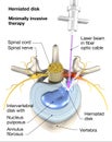 Painful herniated disk, minimally invasive therapy, medically 3D ilustration on white background Royalty Free Stock Photo