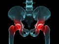 Painful hip