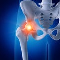 A painful hip joint