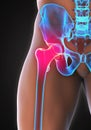 Painful Hip Joint