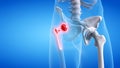 a painful hip replacement