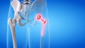 A painful hip replacement