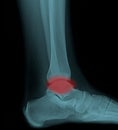 Painful human right foot ankle xray picture internal side