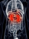 Painful kidney