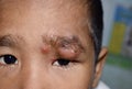 Painful, large abscess or Staphylococcal / Streptococcal skin infection or carbuncles in face of Southeast Asian Burmese child. Royalty Free Stock Photo