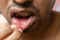 Painful mouth ulcer