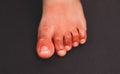 Painful red inflammation on toe called covid toe lesions strange sign of new coronavirus symptoms or infections Royalty Free Stock Photo