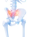 Painful sacrum joint