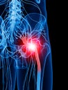 Painful sciatic nerve