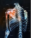 Painful shoulder joints. Shoulder anatomy. Frozen shoulder. Impingement. Concept illustration