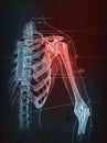 Painful shoulder joints. Shoulder anatomy. Frozen shoulder. Impingement. Medically illustration Royalty Free Stock Photo