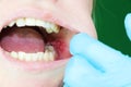 Painful ulcer and stomatitis on the mucous cheek of a girl. After the operation to remove the wisdom teeth. Stitches and