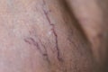 Painful varicose and spider veins