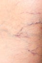 Painful varicose and spider veins on womans legs Royalty Free Stock Photo