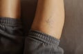 Painful varicose and spider veins on womans legs, who is active at home. Two active seniors in the background. Vascular Royalty Free Stock Photo