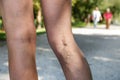 Painful varicose and spider veins on womans legs