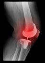 Painfull knee replacement Royalty Free Stock Photo