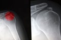 Painfull shoulder, calcific tendonitis, tendinitis Royalty Free Stock Photo