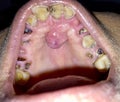 A painless benign growth called palatal torus in the midline of hard palate and broken and stained teeth with caries in mouth.