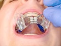 Palatal expander for the maxilla. Lingual braces