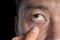 Pale skin of Asian man. Sign of anemia. Pallor at eyelid