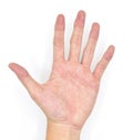Palmar erythema in left hand of Southeast Asian, Chinese young man.